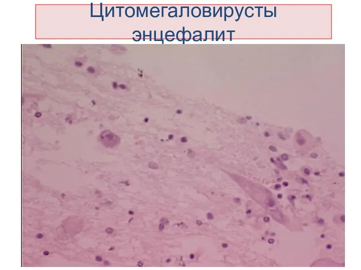 Цитомегаловирусты энцефалит