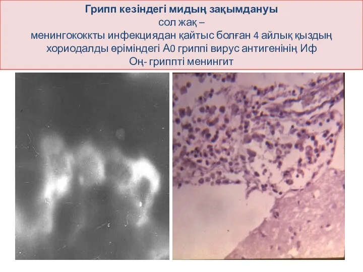 Грипп кезіндегі мидың зақымдануы сол жақ – менингококкты инфекциядан қайтыс