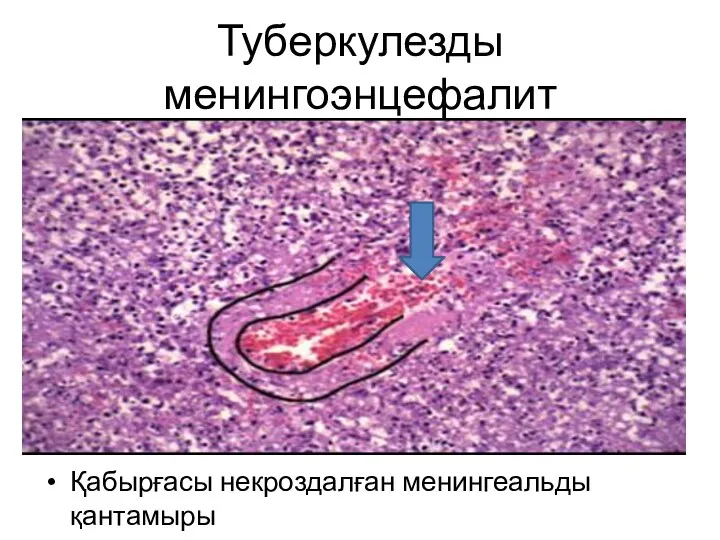 Туберкулезды менингоэнцефалит Қабырғасы некроздалған менингеальды қантамыры