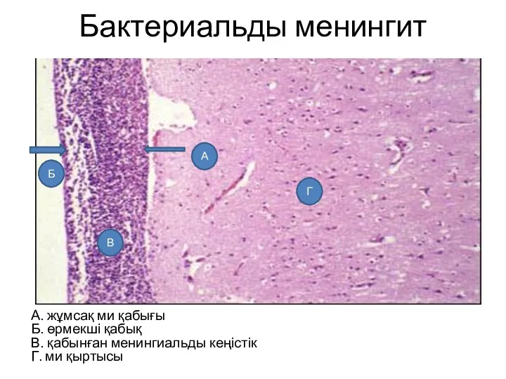 Бактериальды менингит А. жұмсақ ми қабығы Б. өрмекші қабық В.