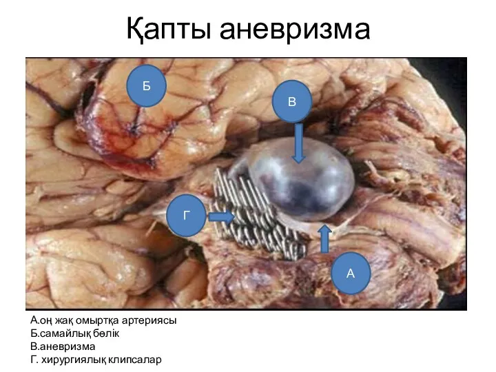 Қапты аневризма А.оң жақ омыртқа артериясы Б.самайлық бөлік В.аневризма Г. хирургиялық клипсалар В Б А Г