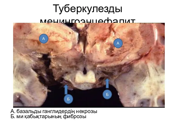 Туберкулезды менингоэнцефалит А. базальды ганглидердің некрозы Б. ми қабықтарының фиброзы А А Б Б