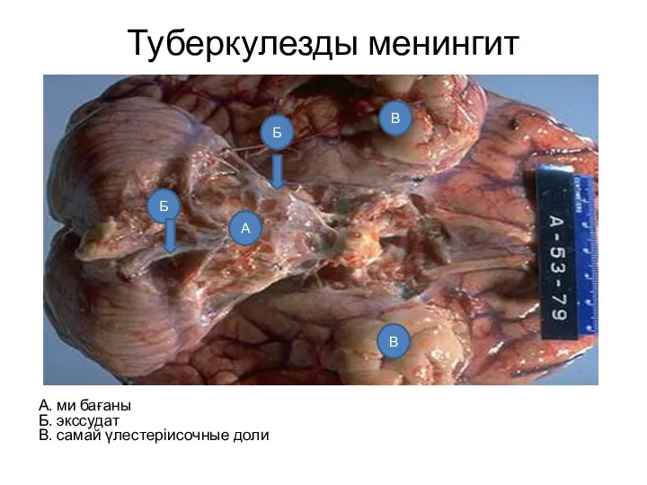 Туберкулезды менингит А. ми бағаны Б. экссудат В. самай үлестеріисочные доли А Б Б В В