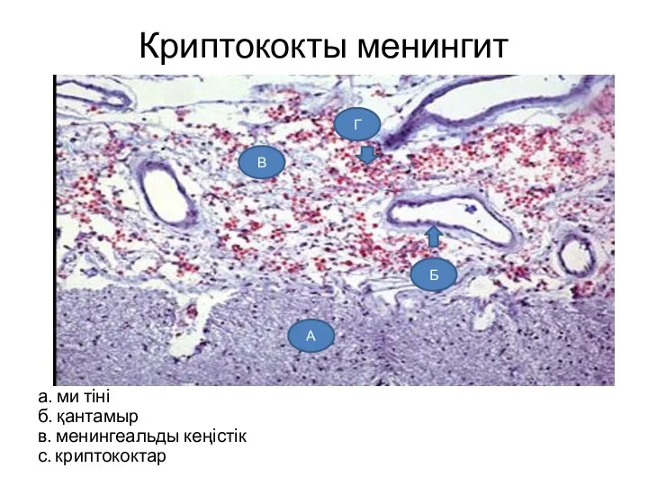 Криптококты менингит а. ми тіні б. қантамыр в. менингеальды кеңістік с. криптококтар А Б В Г