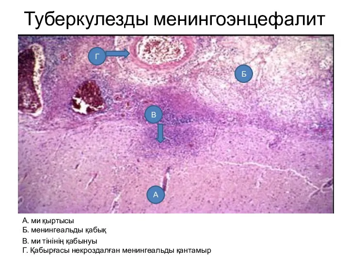 Туберкулезды менингоэнцефалит А. ми қыртысы Б. менингеальды қабық В. ми