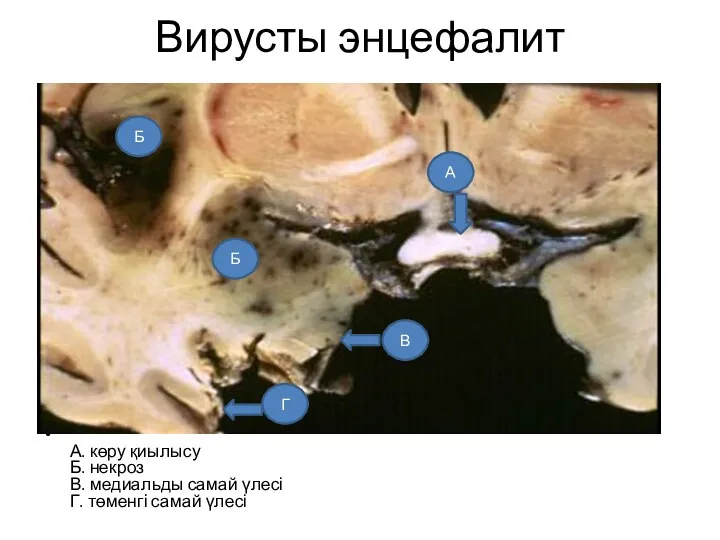 Вирусты энцефалит А. көру қиылысу Б. некроз В. медиальды самай