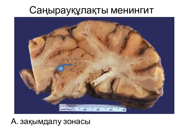 Саңырауқұлақты менингит А. зақымдалу зонасы А