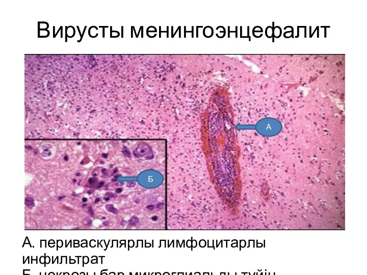 Вирусты менингоэнцефалит А. периваскулярлы лимфоцитарлы инфильтрат Б. некрозы бар микроглиальды түйін А Б