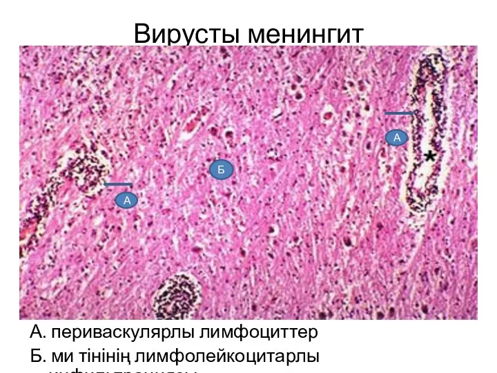 Вирусты менингит А. периваскулярлы лимфоциттер Б. ми тінінің лимфолейкоцитарлы инфильтрациясы А А Б