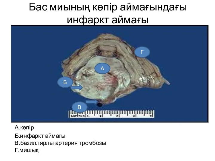 Бас миының көпір аймағындағы инфаркт аймағы А.көпір Б.инфаркт аймағы В.базиллярлы