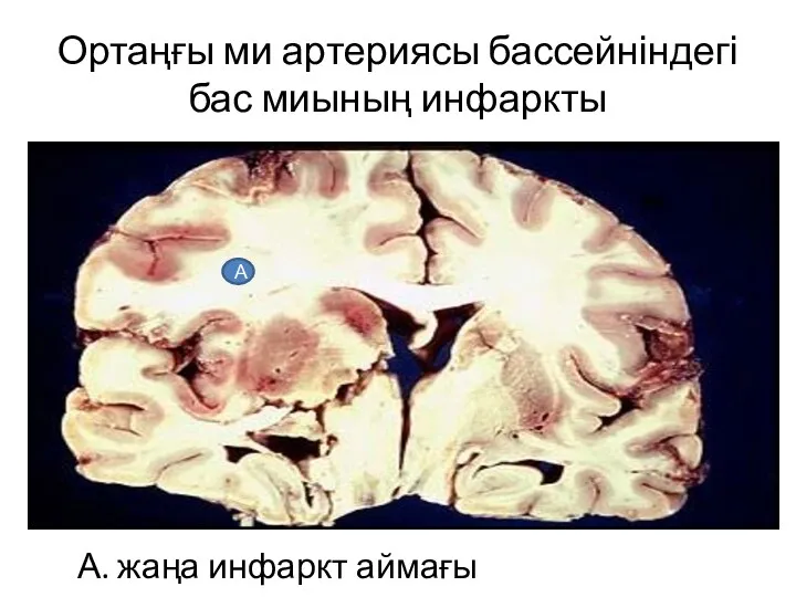 Ортаңғы ми артериясы бассейніндегі бас миының инфаркты А. жаңа инфаркт аймағы А