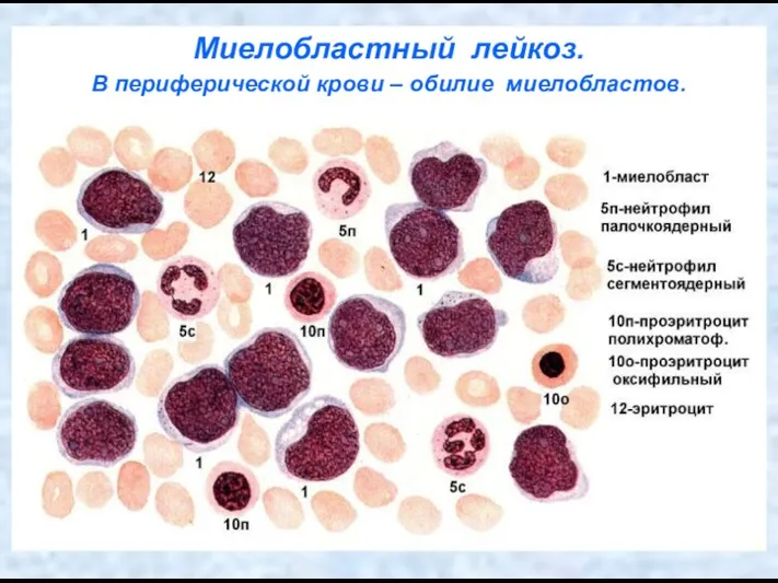 Миелобластный лейкоз. В периферической крови – обилие миелобластов.