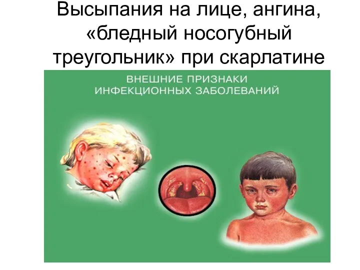 Высыпания на лице, ангина, «бледный носогубный треугольник» при скарлатине