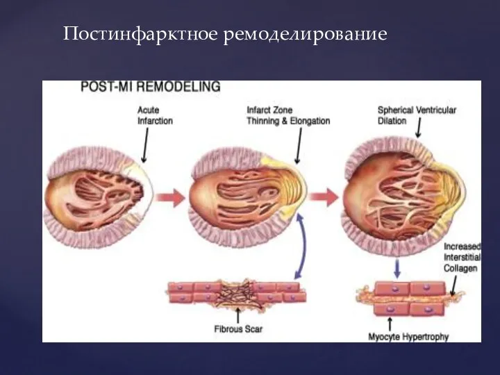 Постинфарктное ремоделирование