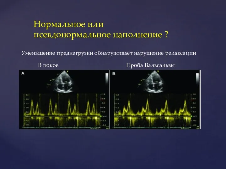 Нормальное или псевдонормальное наполнение ? Уменьшение преднагрузки обнаруживает нарушение релаксации Проба Вальсальвы В покое