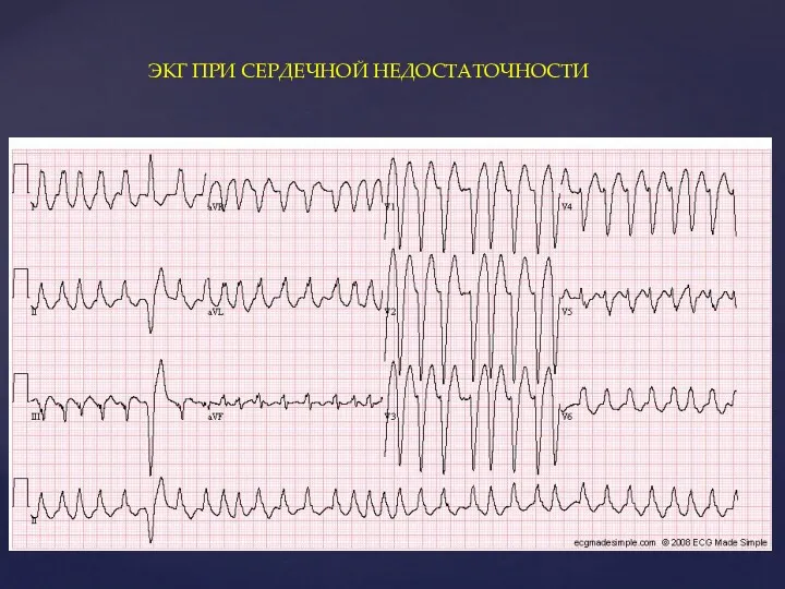 ЭКГ ПРИ СЕРДЕЧНОЙ НЕДОСТАТОЧНОСТИ