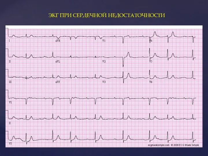ЭКГ ПРИ СЕРДЕЧНОЙ НЕДОСТАТОЧНОСТИ