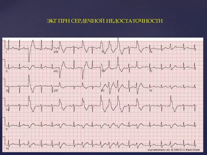 ЭКГ ПРИ СЕРДЕЧНОЙ НЕДОСТАТОЧНОСТИ