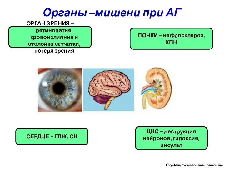 Органы –мишени при АГ ОРГАН ЗРЕНИЯ – ретинопатия, кровоизлияния и