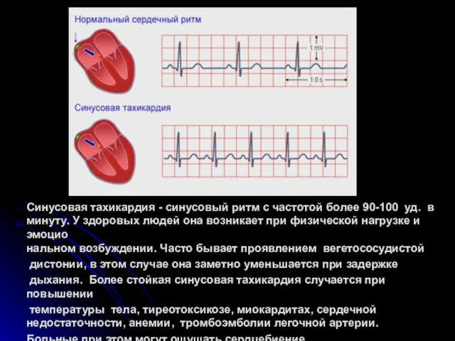 Синусовая тахикардия - синусовый ритм с частотой более 90-100 уд.