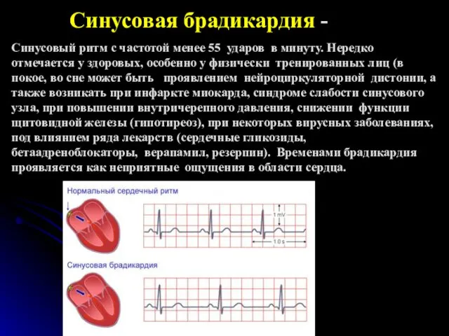 Синусовая брадикардия - Синусовый ритм с частотой менее 55 ударов