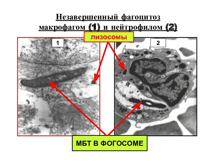 Незавершенный фагоцитоз макрофагом (1) и нейтрофилом (2) лизосомы МБТ В ФОГОСОМЕ 1 2