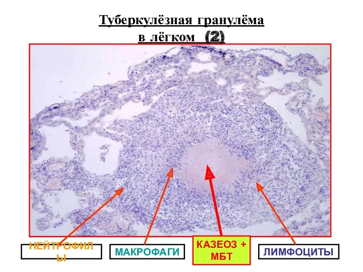 Туберкулёзная гранулёма в лёгком (2) КАЗЕОЗ + МБТ МАКРОФАГИ ЛИМФОЦИТЫ НЕЙТРОФИЛЫ