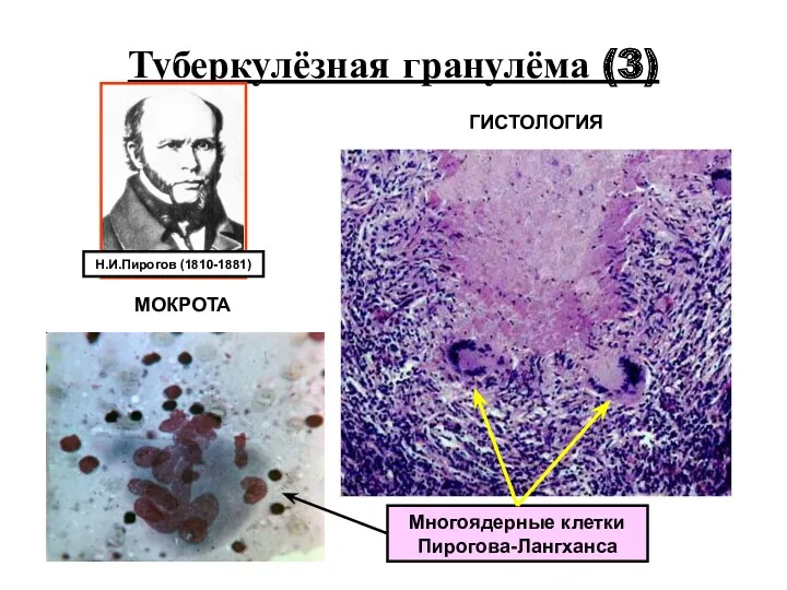 Туберкулёзная гранулёма (3) Многоядерные клетки Пирогова-Лангханса Н.И.Пирогов (1810-1881) ГИСТОЛОГИЯ МОКРОТА
