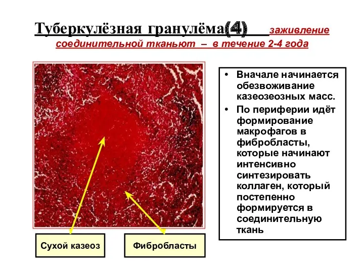 Туберкулёзная гранулёма(4) заживление соединительной тканьют – в течение 2-4 года Вначале начинается обезвоживание
