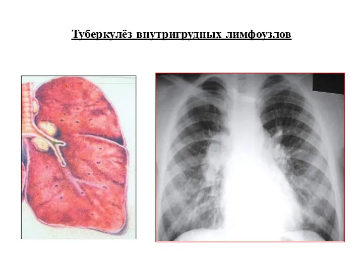 Туберкулёз внутригрудных лимфоузлов
