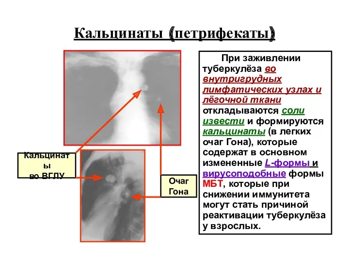 Кальцинаты (петрифекаты) При заживлении туберкулёза во внутригрудных лимфатических узлах и лёгочной ткани откладываются