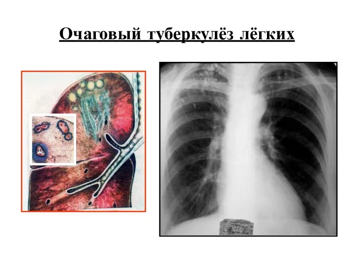 Очаговый туберкулёз лёгких