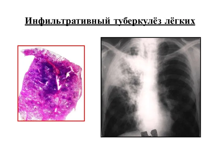 Инфильтративный туберкулёз лёгких