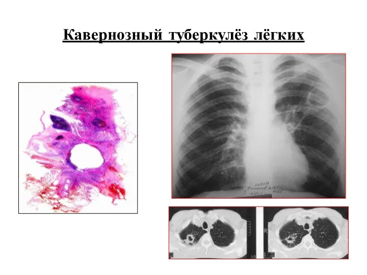 Кавернозный туберкулёз лёгких