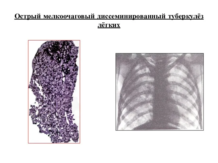 Острый мелкоочаговый диссеминированный туберкулёз лёгких