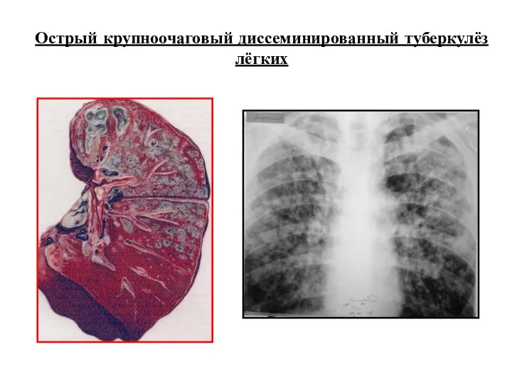 Острый крупноочаговый диссеминированный туберкулёз лёгких
