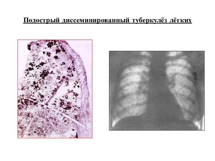 Подострый диссеминированный туберкулёз лёгких