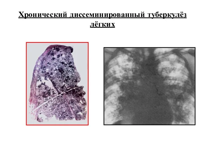 Хронический диссеминированный туберкулёз лёгких