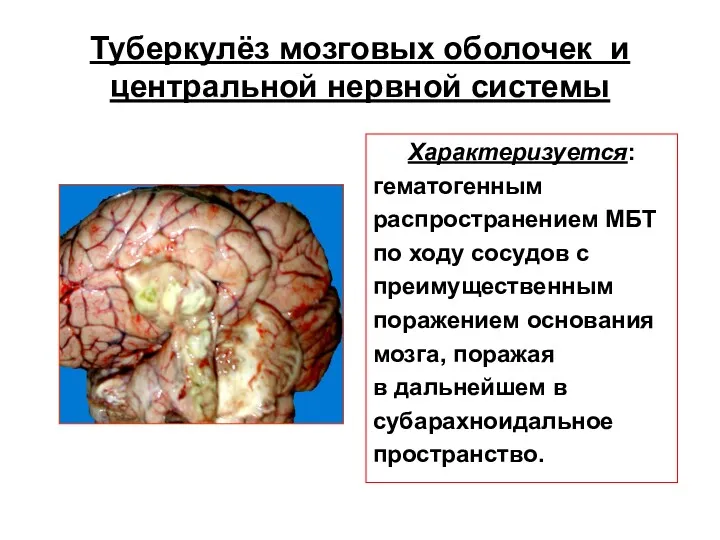 Туберкулёз мозговых оболочек и центральной нервной системы Характеризуется: гематогенным распространением МБТ по ходу