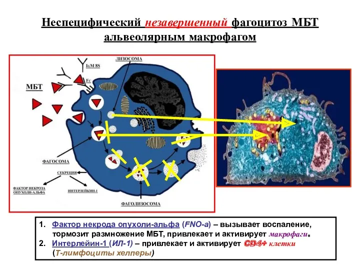 Неспецифический незавершенный фагоцитоз МБТ альвеолярным макрофагом 1. Фактор некрода опухоли-альфа (FNO-a) – вызывает