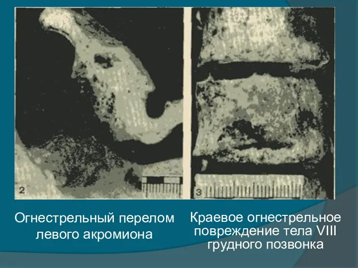 Огнестрельный перелом левого акромиона Краевое огнестрельное повреждение тела VIII грудного позвонка