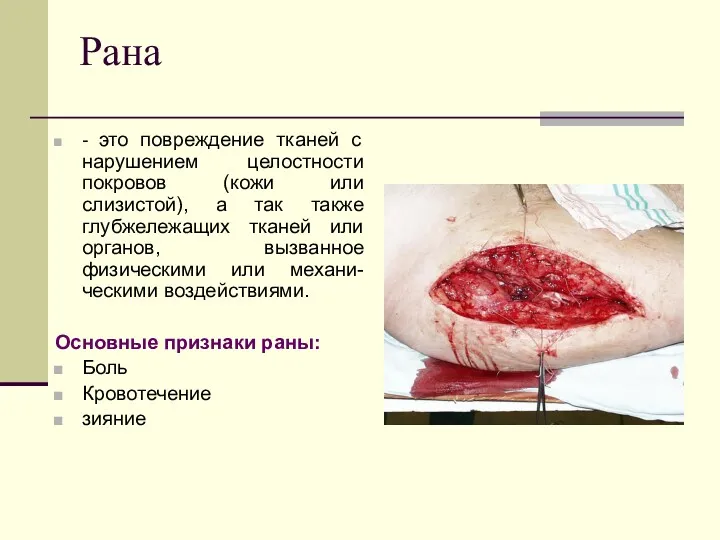 Рана - это повреждение тканей с нарушением целостности покровов (кожи