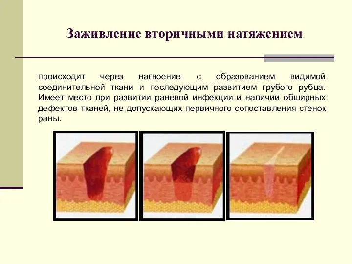 Заживление вторичными натяжением происходит через нагноение с образованием видимой соединительной