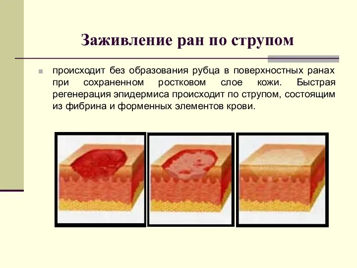 Заживление ран по струпом происходит без образования рубца в поверхностных