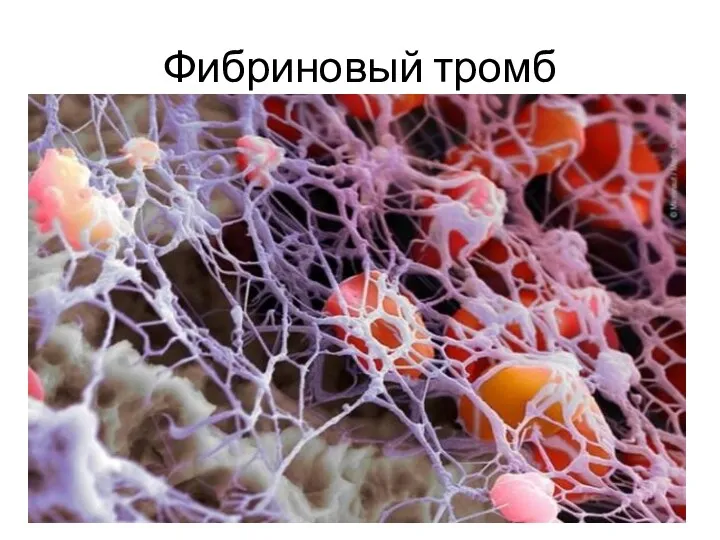 Фибриновый тромб