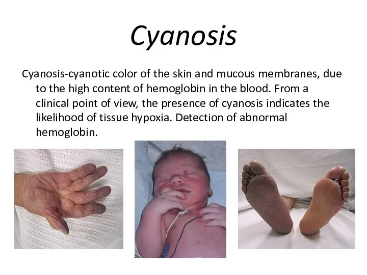 Cyanosis Cyanosis-cyanotic color of the skin and mucous membranes, due