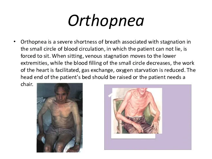 Orthopnea Orthopnea is a severe shortness of breath associated with