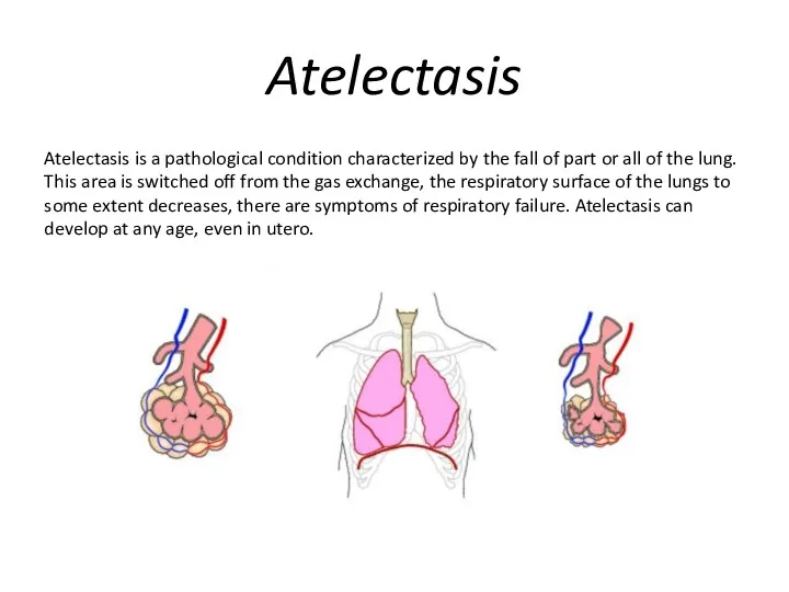 Atelectasis Atelectasis is a pathological condition characterized by the fall