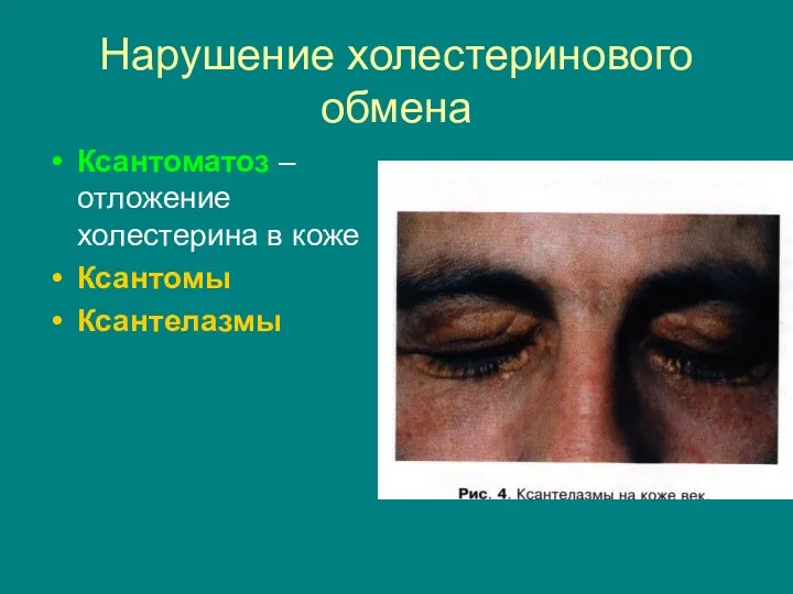 Нарушение холестеринового обмена Ксантоматоз – отложение холестерина в коже Ксантомы Ксантелазмы