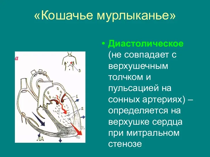 «Кошачье мурлыканье» Диастолическое (не совпадает с верхушечным толчком и пульсацией